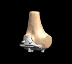 Individual Patient Specific Jigs Applied to Bone