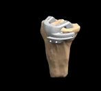 Custom Patient Specific Jigs Applied to Patients Bone