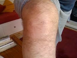 Post operation knee arthroscopy